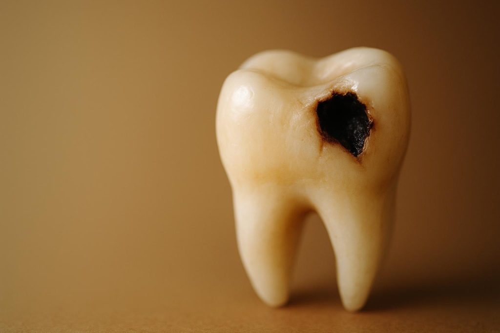 Close-up of a tooth with a small cavity, illustrating the risks of not getting a cavity filled.